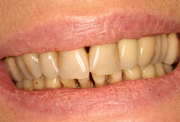 Dents marrons et mobilité dentaire