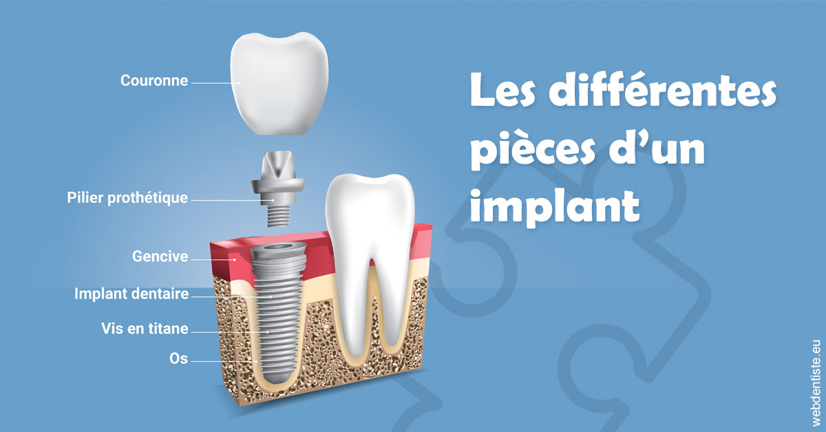 https://damiani-richelme.test.moncomptewebdentiste.fr/Les différentes pièces d’un implant 1