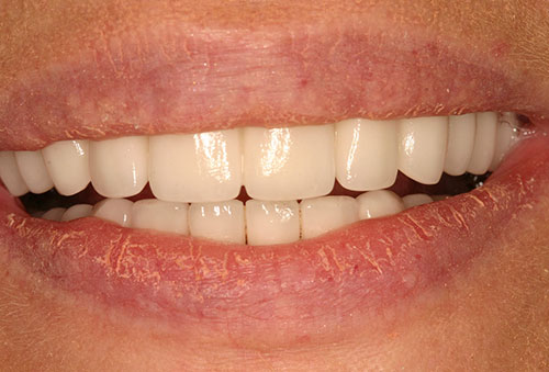 dents-marrons-et-mobilite-dentaire-dr-richeleme-apres